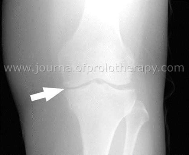 Prolozone Therapy Alta Mountain Chiropractic