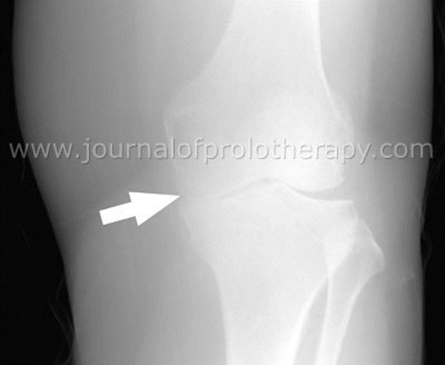 Prolozone Therapy Alta Mountain Chiropractic